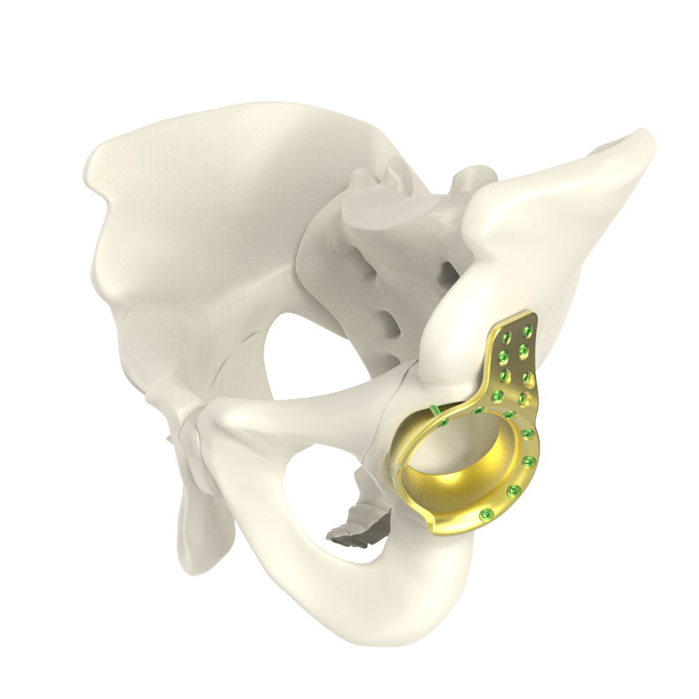 ARRP - Acetabulum roof reinforcement plate